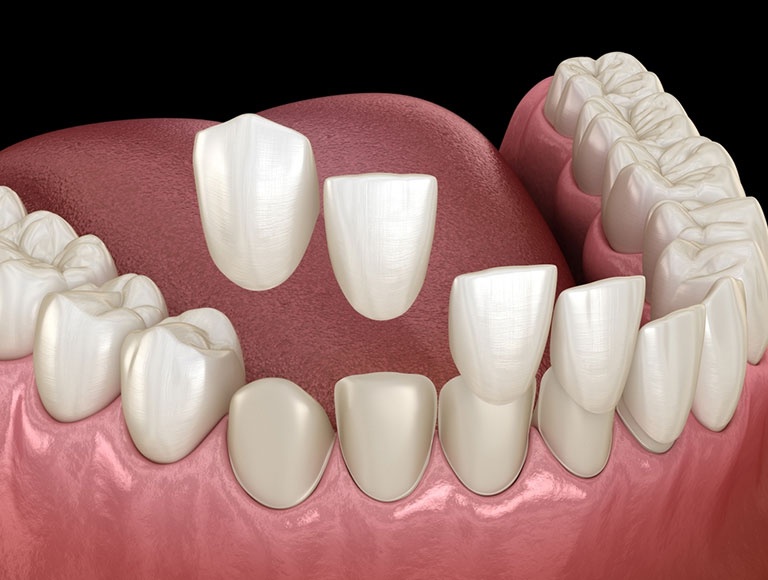 What Are Dental Veneers?